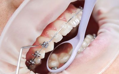 ¿Qué beneficios aporta un tratamiento de ortodoncia?